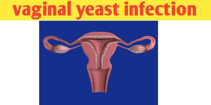 Vaginal yeast infection causes, symptoms, discharge and home remedies